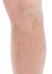 Calf with fine spider veins