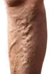 Calf with bulging, twisted varicose veins