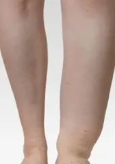 Lower legs with swollen ankles