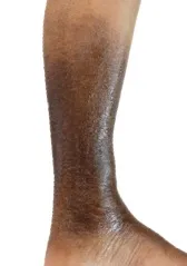 Lower leg with darkened, discolored skin near the ankle